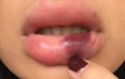 Về phần mình, Burko vẫn mong muốn tiêm filler trở lại, nhưng sẽ chọn một địa chỉ đáng tin cậy, như cơ sở thẩm mỹ từng thực hiện ở 6 lần trước. (Ảnh minh hoạ)