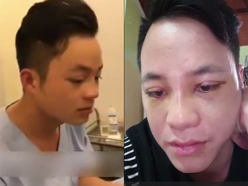 Hình ảnh sau khi được vợ chi tiền cho đi nhấn mí của chú rể 26 tuổi.