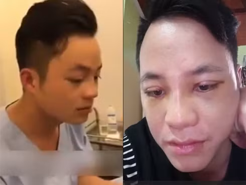 Hình ảnh sau khi được vợ chi tiền cho đi nhấn mí của chú rể 26 tuổi.