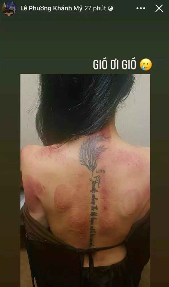 Theo đó, gái xinh đình đám một thời chụp phần cánh tay và lưng xuất hiện dày đặc vết sứt sát đỏ, bầm tím.