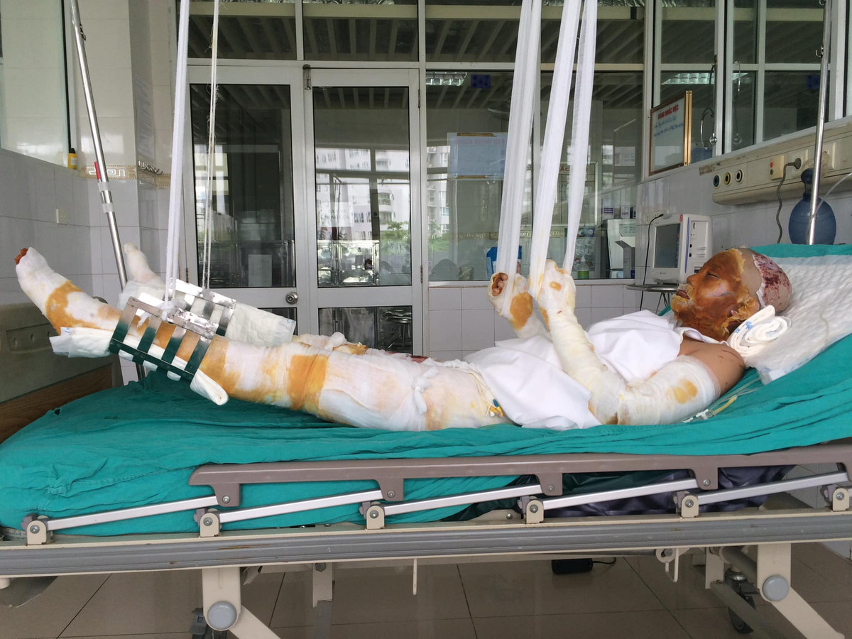 Cụ thể, năm 2016 khi tham gia trang trí cho lễ khai giảng, không may Trang Milk bị bỏng nặng toàn thân do quả bóng bay phát nổ. Cô gái Thái Nguyên chia sẻ: "Lúc bị bỏng, tôi vẫn còn tỉnh táo tìm chỗ có nước để xả vào khuôn mặt với hy vọng không để lại vết thương trên mặt. Sau đó, tôi được chuyển vào Bệnh viện đa khoa Thái Nguyên băng bó rồi ngay lập tức chuyển xuống Viện Bỏng quốc gia để điều trị".