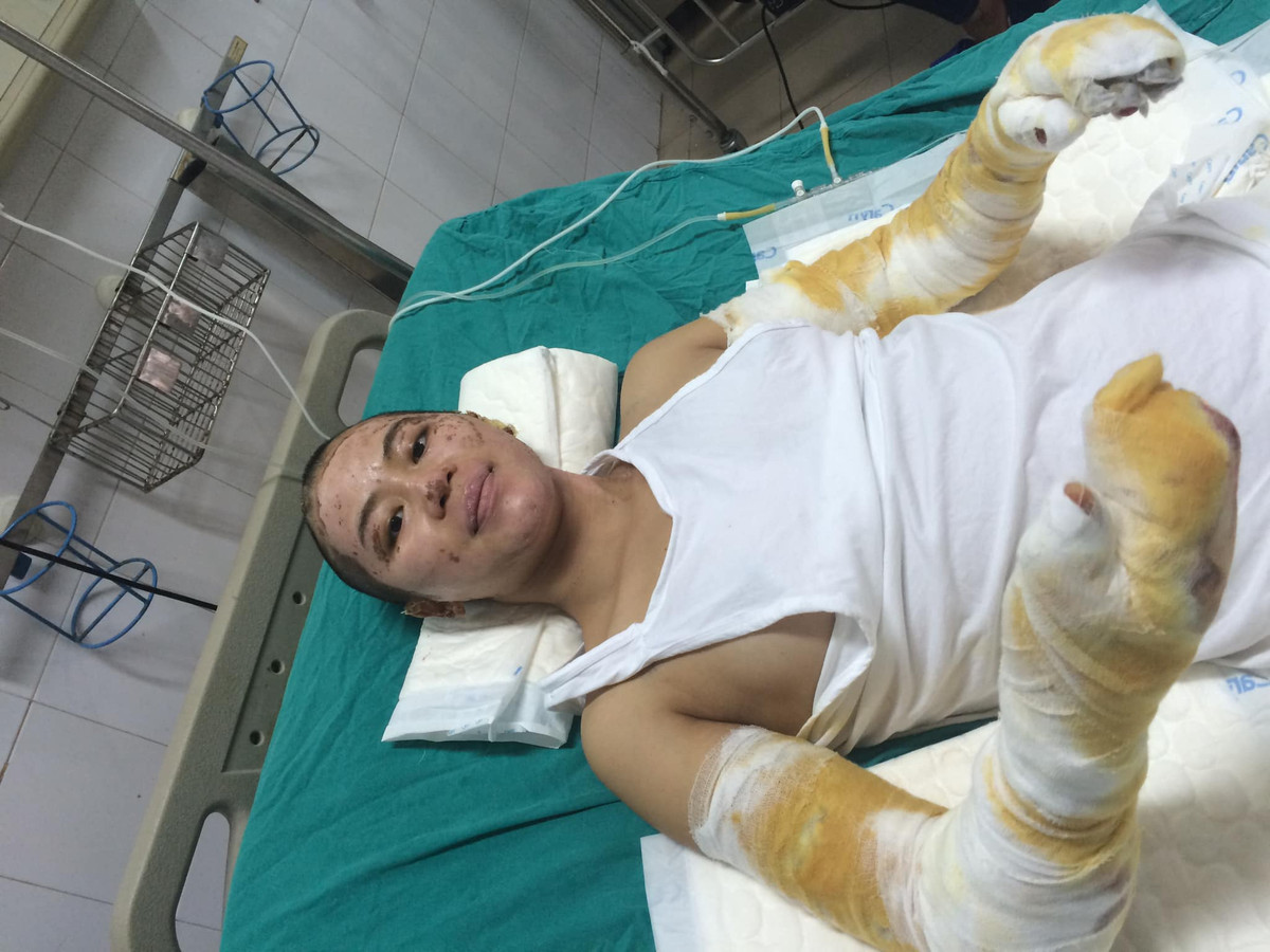 Nằm điều trị 1 tháng ở phòng cấp cứu và 10 ngày ở phòng phục hồi chức năng, gia đình Trang Milk phải mất 1 khoản tiền khá lớn. Chưa dừng lại đó, đây là khoảng thời gian khó khăn và ám ảnh cuộc đời của cô.