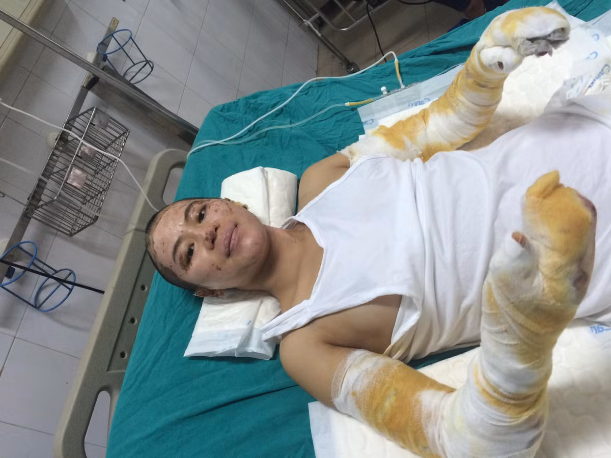 Nằm điều trị 1 tháng ở phòng cấp cứu và 10 ngày ở phòng phục hồi chức năng, gia đình Trang Milk phải mất 1 khoản tiền khá lớn. Chưa dừng lại đó, đây là khoảng thời gian khó khăn và ám ảnh cuộc đời của cô.