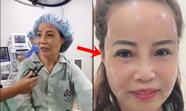 Trước đó, sau khi thực hiện phẫu thuật, cô dâu 62 tuổi Cao Bằng không ngần ngại chia sẻ hình ảnh hiện tại của bản thân cũng như livestream nói chuyện cùng mọi người với gương mặt sưng phù, băng bó kín mít xung quanh.