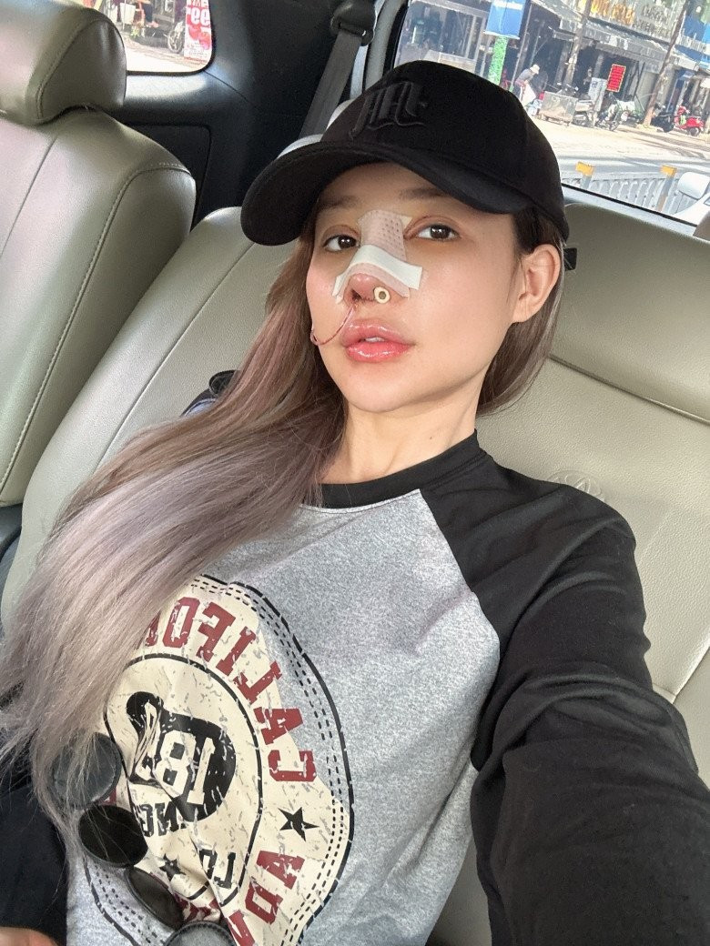 Mới đây, Ngân 98 làm nhiều người bất ngờ khi tiếp tục công khai hình ảnh chỉnh sửa nhan sắc. Người đẹp quê Bình Định chia sẻ loạt ảnh với chiếc mũi đang được nẹp kỹ lưỡng, gương mặt vẫn còn sưng khá to kèm dòng đăng tải: "Sưng chù vù luôn rồi, chỉ có 10 ngày để nghỉ ngơi".