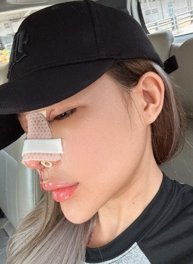 Ngân 98 không ngại chia sẻ hình ảnh cận mặt sau ca phẫu thuật. Phần mũi của cô vẫn còn đang được nẹp kỹ lưỡng. Nhiều người cũng nhận ra Ngân 98 trong dịp này dường như cũng đã cắt mí.