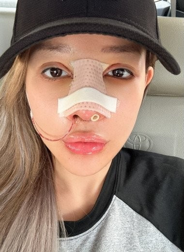 Không giấu diếm, Ngân 98 tiếp tục chia sẻ việc "dao kéo" của mình. Cô cho biết bản thân vừa mới sửa mũi.