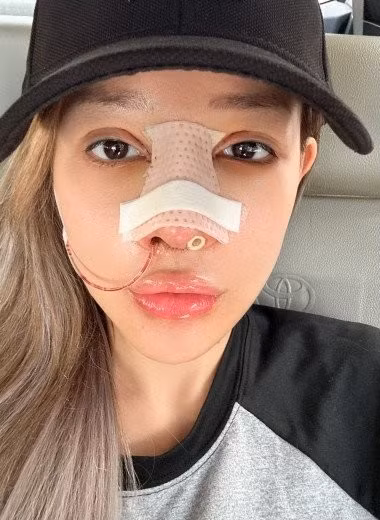 Không giấu diếm, Ngân 98 tiếp tục chia sẻ việc "dao kéo" của mình. Cô cho biết bản thân vừa mới sửa mũi.