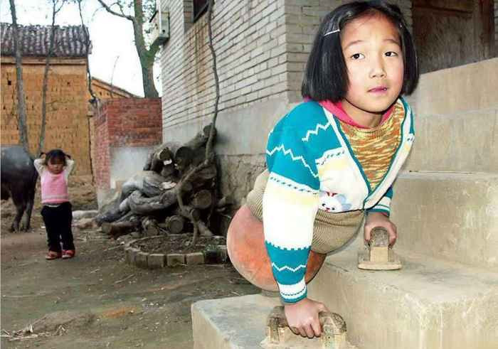 Vì gia đình quá khó khăn, không đủ điều kiện kinh tế để lắp chân giả cho Tiền Hồng Diễm. Ông nội của cô bé đã cắt một quả bóng rổ lắp vào người cháu gái để cô bé có thể di chuyển dễ dàng hơn với sự trợ giúp của hai cánh tay.