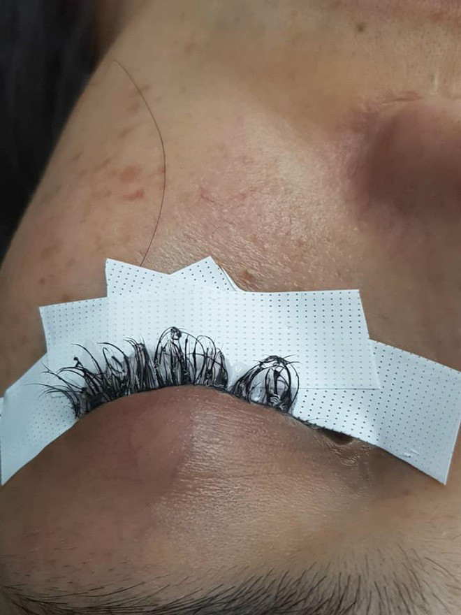 Nối mi thì phải dùng đến keo nên có trường hợp bị dị ứng dẫn đến viêm da vùng mi hay viêm kết mạc. Thậm chí, nguy hiểm hơn chính là hỏng giác mạc do biến chứng sau nối mi.