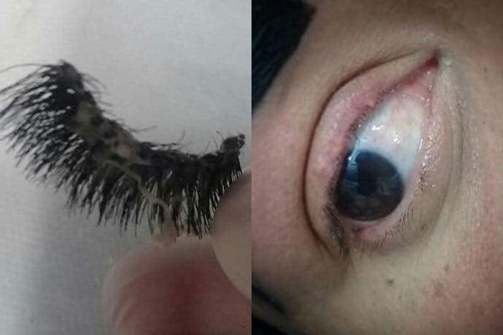 Đáng nói hơn, nối mi hỏng không chỉ gây mất thẩm mỹ mà còn có thể ảnh hưởng đến mắt cũng như sức khỏe của người nối.