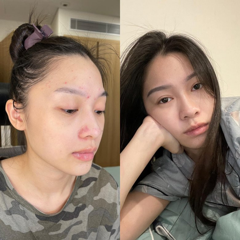 Là MC VTV, giữ dáng là điều quan trọng, song với các mỹ nhân này, chăm sóc da là việc quan trọng hơn. Hạnh Quyên cũng từng có khoảng thời gian stress vì mụn do make-up quá nhiều. Cô từng phải cầu cứu đồng nghiệp vì tình trạng da mặt tệ, nhiều mụn ẩn, đầu đen và cô không tự xử lý được.