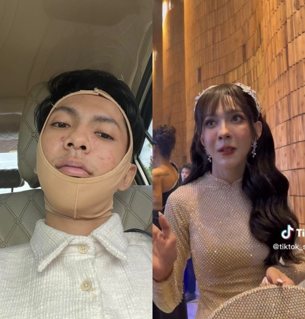 Trước đó, má Cám cũng từng làm răng sứ, tiêm filler, thu gọn cánh mũi.