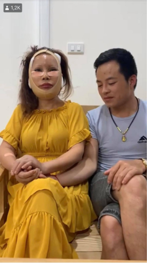 Sau khi thực hiện phẫu thuật, cô dâu 62 tuổi Cao Bằng không ngần ngại chia sẻ hình ảnh hiện tại của bản thân cũng như livestream nói chuyện cùng mọi người với gương mặt sưng phù, băng bó kín mít xung quanh.