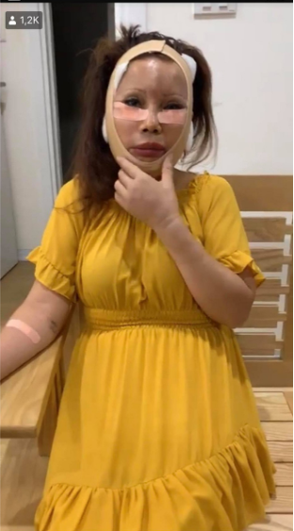 Trong lần "trùng tu" này, cô dâu Thu Sao thực hiện kéo căng da mặt, tiêm mỡ làm đầu trán.