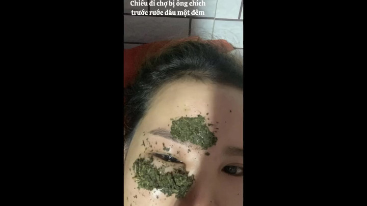 Đám cưới xong xuôi, Phát Đạt chở vợ đi bệnh viện khám xét kỹ lưỡng. Anh Thư được chẩn đoán bị viêm giác mạc, được kê thuốc uống và bôi. Sau 5 ngày tích cực điều trị, cô nàng đã lấy lại được diện mạo bình thường.