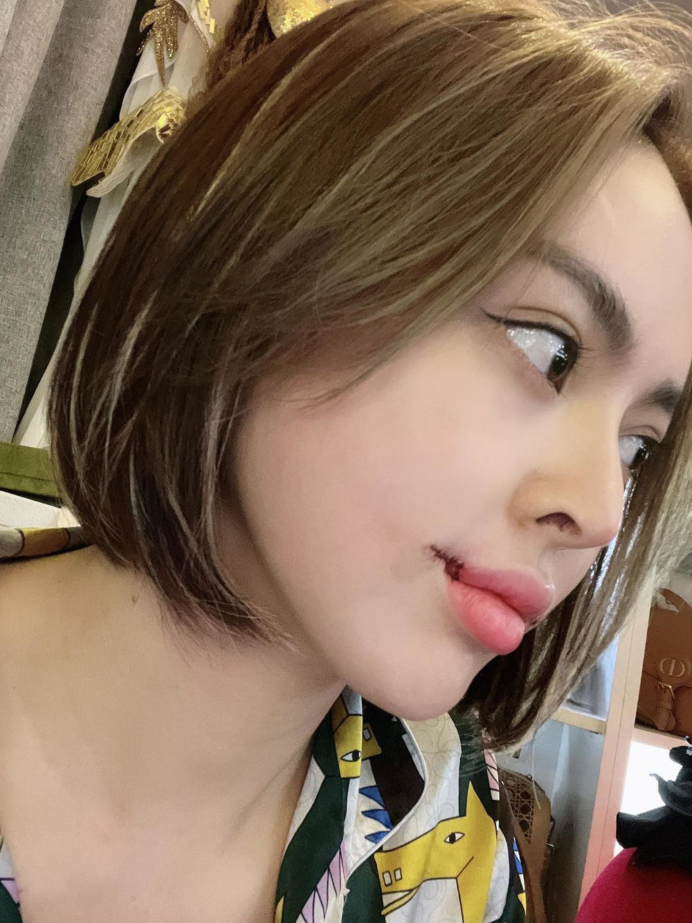 Song có vẻ những phương pháp chăm sóc nhan sắc bình thường vẫn chưa đủ nên mới đây, Trang Nemo đã chọn cách động dao kéo khi phẫu thuật khóe miệng để có khuôn miệng đẹp và nụ cười tươi như ý.