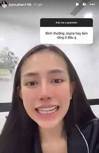 Trước đây, mũi Joyce Phạm không được cao, phần cánh mũi bị to.