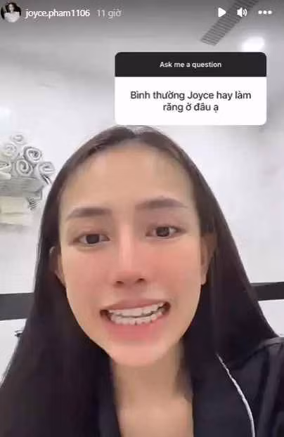 Trước đây, mũi Joyce Phạm không được cao, phần cánh mũi bị to.