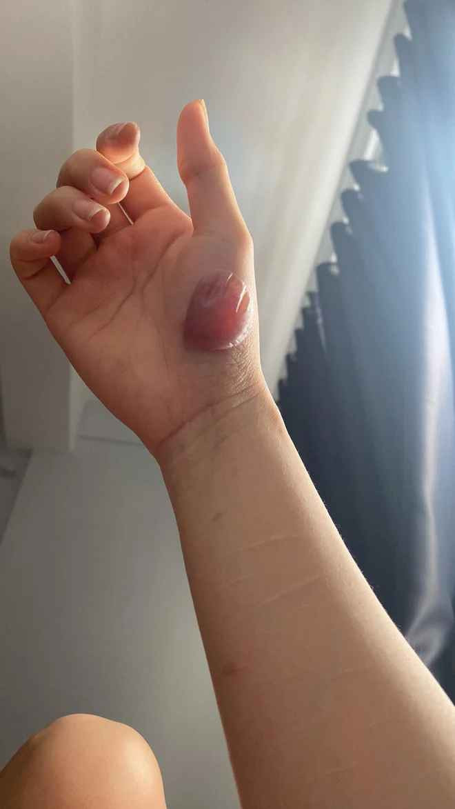 Mới đây, trong một đoạn clip, hot girl dân tộc Tày gây chú ý bởi những vết thương trên cánh tay. Điều này khiến người hâm mộ lo lắng cho sức khỏe của cô nàng.