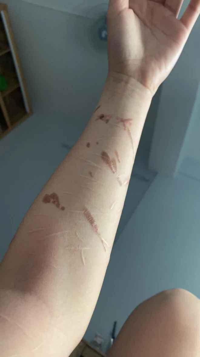 Ceri Thu Hà cho biết thời gian gần đây sơ suất bị bỏng dầu ăn nên tay xuất hiện các vệt đỏ: “Các vết bỏng cũng khá nhiều và lớn, hiện tại mình đang bôi thuốc rồi nhưng để lành hẳn có lẽ sẽ hơi khó hoặc mất nhiều thời gian”.