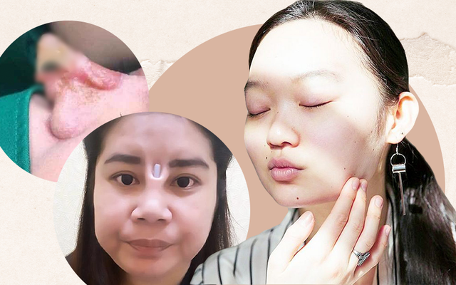 Không ít trường hợp, các cô gái bị hoại tử vùng mũi, trán sau khi tiêm filler làm đẹp.