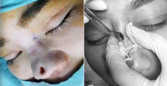 Cận cảnh chiếc mũi thủng lỗ khiến ai nhìn cũng rùng mình. Đi kèm hình ảnh, cô gái gửi lời cảnh tỉnh đến mọi người: "Nói thật với mấy chị em, đừng ham (nâng mũi) cao vì không bền đâu ạ...".