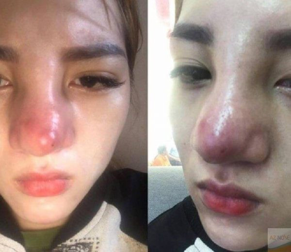 Trong hình ảnh, cô gái được sử dụng miếng độn mũi, nhưng sau một thời gian, mũi đã bị sưng tấy, viêm và đau nhức.