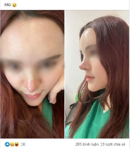 Không thể phủ nhận một chiếc mũi cao góp phần rất lớn trong việc cải thiện gương mặt. Nhưng cái gì cũng có hai mặt, có người làm thì đẹp lên nhưng có người lại gặp phải biến chứng.
