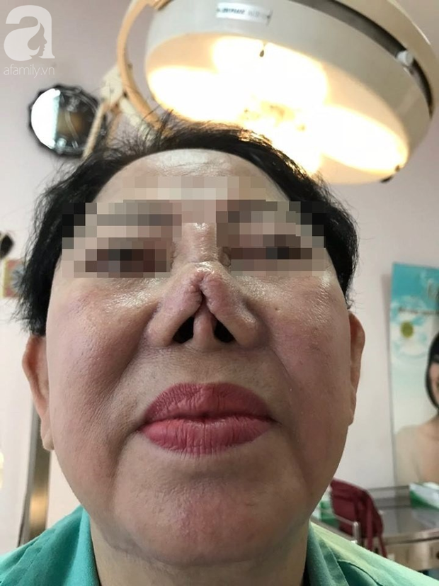 Chưa hết nhiều cô gái còn bị rơi vào tình cảnh mũi biến dạng và hạn chế đường thở vì phẫu thuật thẩm mỹ nâng mũi.