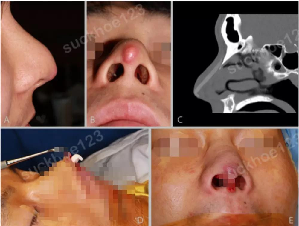 Trong ảnh, cô gái với chiếc mũi vẫn đang được băng bó. Đáng chú ý, phần sống mũi không những sưng vù mà còn nhô một đoạn lên tận trán nghi là sụn mũi sắp thủng.