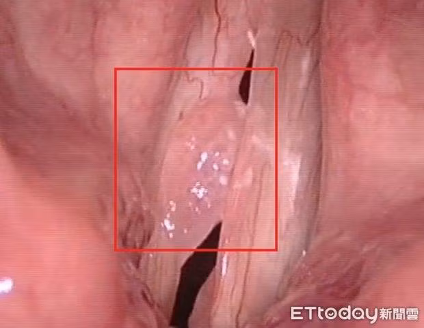 “Qua dem” voi gai la va cai ket dau don vi tuong bi ung thu cua quy ong-Hinh-2