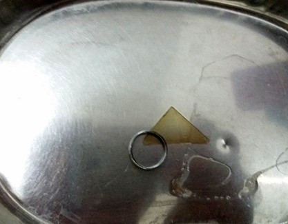 Vòng kim loại sau khi được lấy ra khỏi thực quản bệnh nhi.