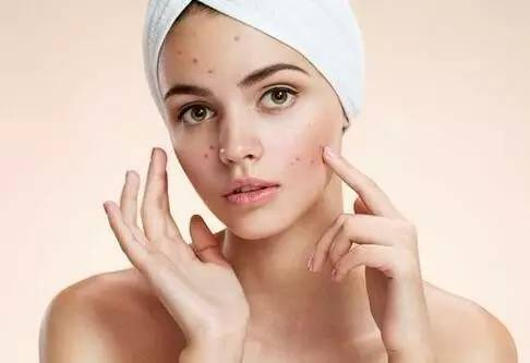 Khi sức khỏe của gan giảm sút sẽ khiến việc bài tiết chất nhờn giảm sút nên dễ nổi mụn.