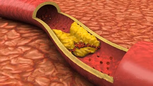 Để giúp "dọn" sạch huyết quản, cải thiện những bệnh nguy hiểm về máu, bạn có thể lựa chọn các thực phẩm sau đây.