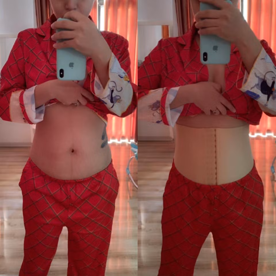 Bi kip lay lai eo thon sau sinh cua Hai Bang khien bac si kinh hai-Hinh-3