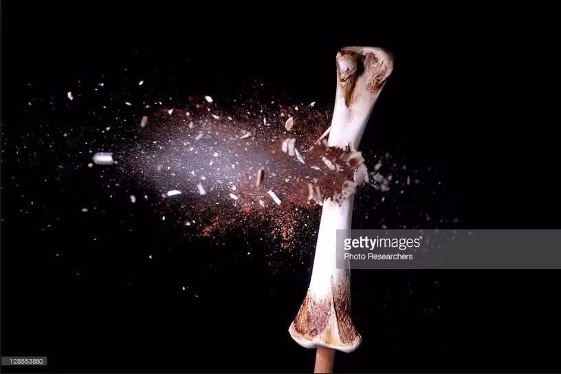 Một nỗi ám ảnh kinh hoàng khác chính là trường hợp đạn 5,56x45 mm của khẩu M16 bắn trúng vào xương của nạn nhân. Do có gia tốc quá lớn, viên đạn này sẽ làm vỡ hoàn toàn xương của người trúng đạn, gây ra nhiều mảnh vỡ hơn nữa lan ra bên tỏng cơ thể nạn nhân. Nguồn ảnh: Gettyimg.