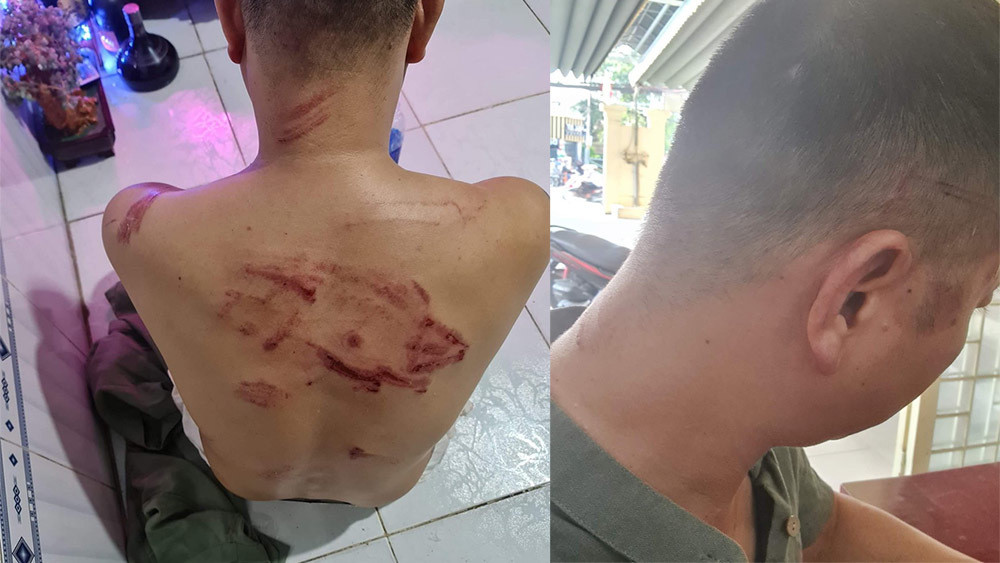  Hàng chục giang hồ xông vào nhà chém người ở Sài Gòn: 23h20 tối 4/9, ông V.H.V (SN 1973) chở vợ và 2 con vừa về đến nhà ở hẻm số 68, đường Phan Huy Ích, phường 12, quận Gò Vấp. Lúc này có hơn chục đối tượng cầm theo hung khí đi đến trước cửa, một trong số các đối tượng hỏi lớn “mày nói gì với Quang chùa mà chúng nó chém nhau?”. Đến giờ, ông V vẫn khẳng định, không biết Quang chùa là ai, và nghĩ đây là sự nhầm lẫn.