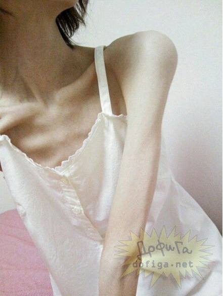 Mới đây, hình ảnh một thiếu nữ gầy gò như "bộ xương di động" đến phát hoảng đang được lan truyền khắp các diễn đàn, trang mạng nhiều nước châu Á như Trung Quốc, Việt Nam, Thái Lan,…