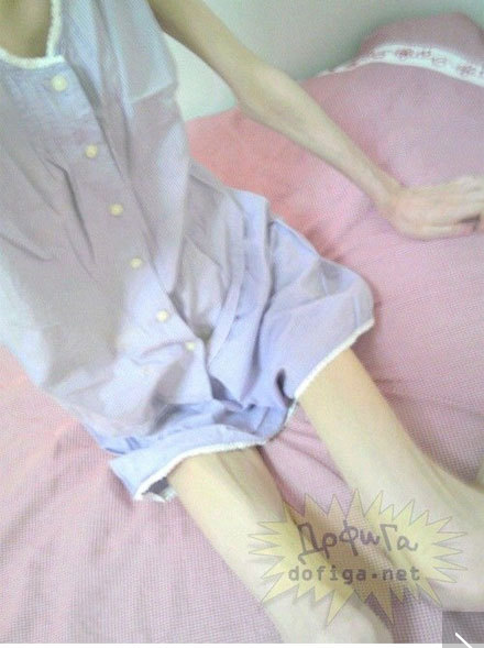 Hiện mọi người vẫn chưa biết chính xác căn bệnh lạ khiến cô gái dẫn đến tình trạng này.