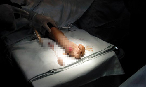 Bo phan co the dut lia duoc noi lai bang cach nao?