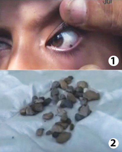 Bé Saadiya Saleh khiến các bác sĩ bối rối khi phải ca đựng đá rơi ra từ mắt mình