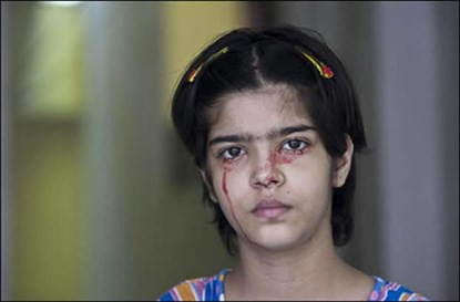 Cô bé Twinkle Dwivedi, 14 tuổi đến từ Uttar Pradesh, Ấn Độ cũng mắc căn bệnh giống Cedeno.