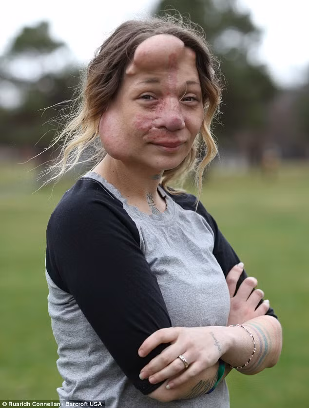 Những quả bóng này được bơm thêm nước muối mỗi tuần để làm căng da mặt Jennifer Hiles. 