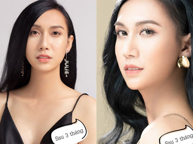 Qua loạt ảnh được Lynk Lee chia sẻ, nhiều người cho rằng quá trình chuyển giới của Lynk Lee đầy đau đớn. Ngoài ra, theo lời Lynk Lee, thời gian đầu sau khi nâng ngực, cô nhức đến độ không thể đưa tay lên.