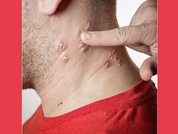 Nhiễm virus. Ngay cả bị nhiễm virus như zona thần kinh có thể gây đau ngực. Ở một vài trường hợp, thiếu máu đến các mô phổi cũng có thể gây ra các cơn đau ngực.