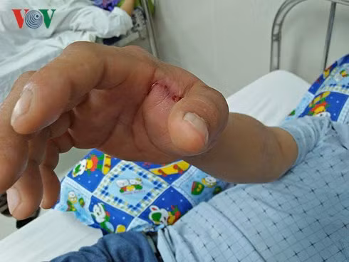 Một bệnh nhân bị rắn độc cắn vào tay (Ảnh: VOV). Một bệnh nhân bị rắn độc cắn vào tay (Ảnh: VOV).