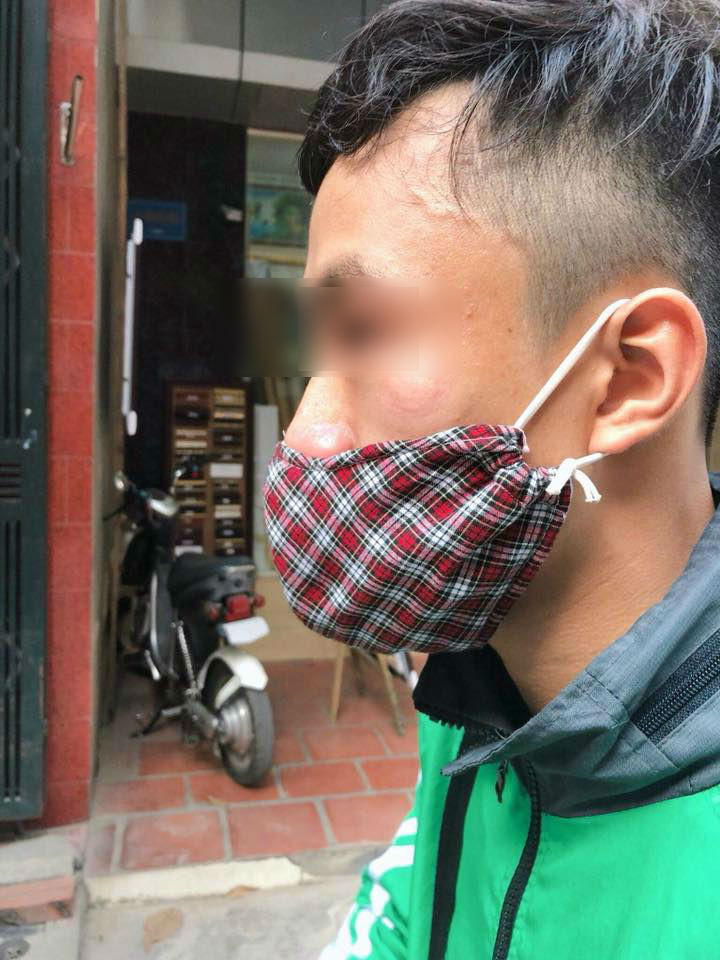 Tài xế Grab Bike bị một người đàn ông vô cớ đấm vào mặt. Ảnh: Joog Nguyen.