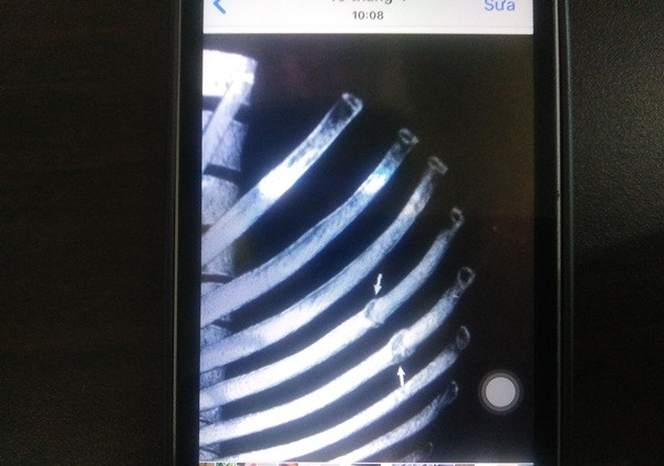 Hình ảnh vị trí hai xương sườn anh Hưng bị ông Lự đánh.