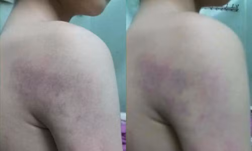 Hình ảnh cháu T. bị cô giáo đánh thâm tím khắp cơ thể.